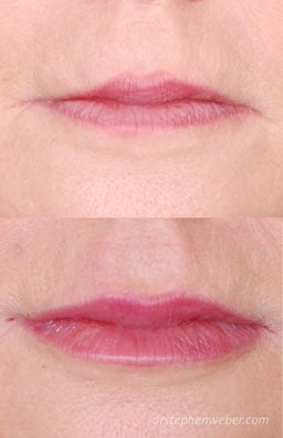 Restylane Lip Injection before 222099