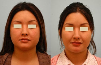 Botox Jaw Reduction before 136829