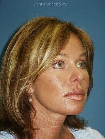 Facelift, Endoscopic Browlift, Upper and Lower Blepharoplasty after 248938