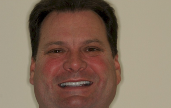 Full mouth dental reconstruction 90862