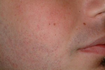 Acne treatment with Accutane photo from Mary P. Lupo, MD ...