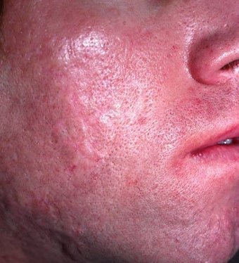 Acne Scarring after 157587