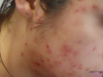 Severe Acne - Photodynamic Treatment before 271950