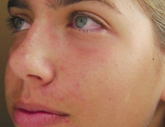 Acne treatment after 376130