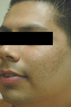 Acne Laser Treatment after 88206