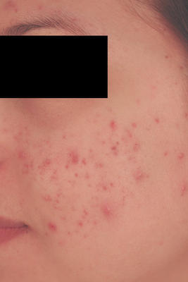 Laser Acne Treatment before 82988