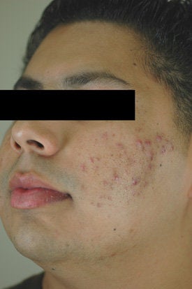 Acne Laser Treatment before 88206
