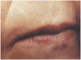 active fx fractional Co2 resurfacing after 267555