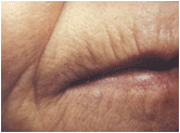 active fx fractional Co2 resurfacing before 267555