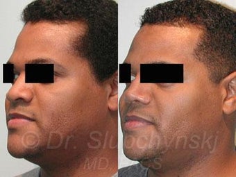 African American Rhinoplasty after 374018