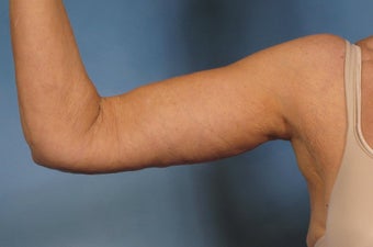 Arm Lift after 125541