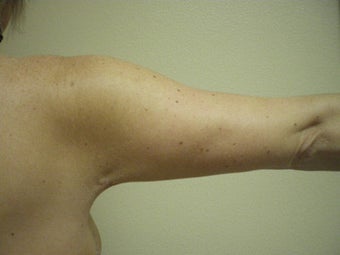 Arm Lift after 155760