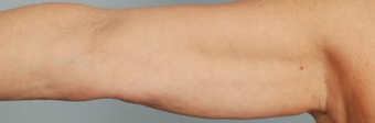 Brachioplasty before 100304