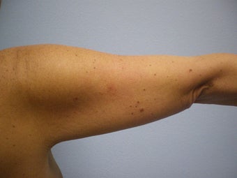Arm Lift before 155760
