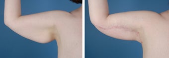 Arm Lift (Brachioplasty) after 303701
