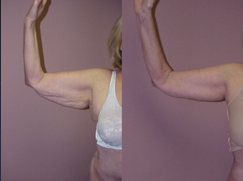 Arm Lift after 350328