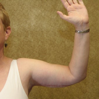 Brachioplasty or arm tuck after 583684