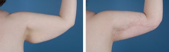 Arm Lift (Brachioplasty) before 303701