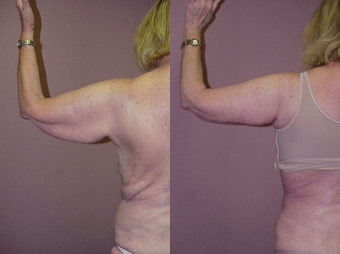 Arm Lift before 350328