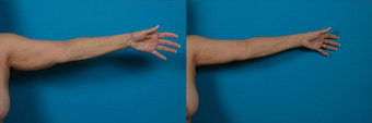 Arm Lift before 574593