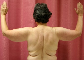 Brachioplasty or arm tuck in los angeles before 583674