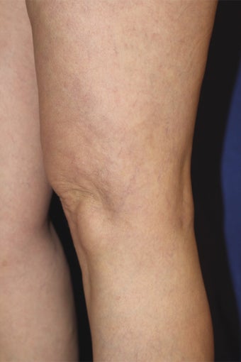 spider vein treatments