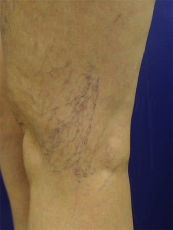 spider vein treatments