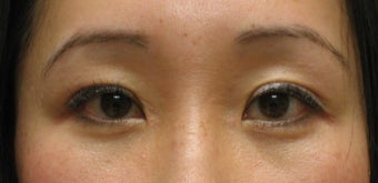 Upper and lower blepharoplasty by CO2 laser after 259539