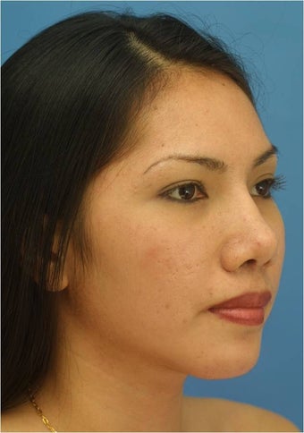 Rhinoplasty after 421673