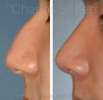 Nose before 431412
