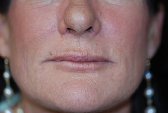 Belotero for vertical lines around the lips after 581285