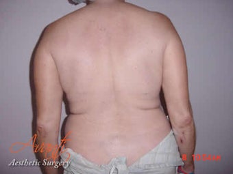 Body Jet before 379520