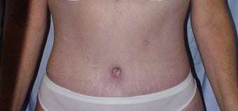 Circumferential body lift and Liposuction after 118294