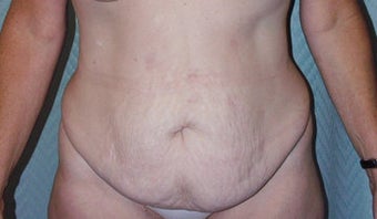 Circumferential body lift and Liposuction before 118294