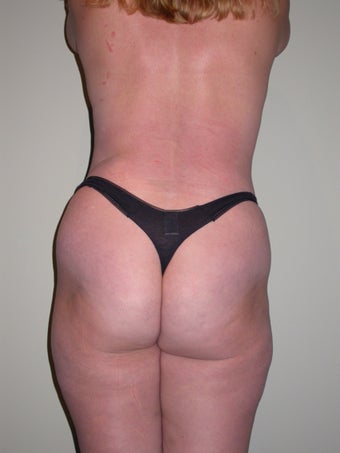 Breast lift, abdominoplasty, liposuction before 273340