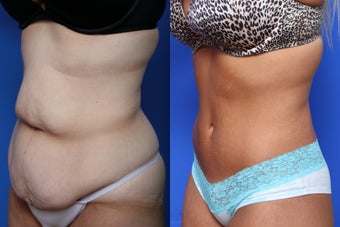 Body Lift 623701