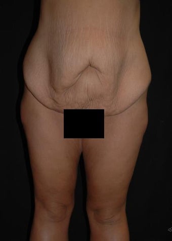 29 year old female treated for excess skin and weight. before 640860