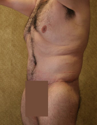 body lift after 304707