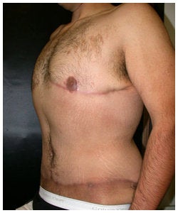 Body Lift and Male Breast Reduction after 334375
