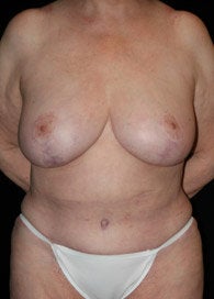 Body Lift after 363605