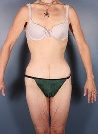 After Weight Loss, Body Lift after 382294