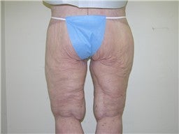 Body Lift after 482781
