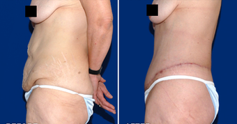 Lower Body Lift after 495816