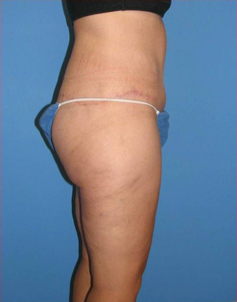 Body Lift after 529678
