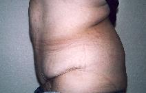 Body Contouring after 557016