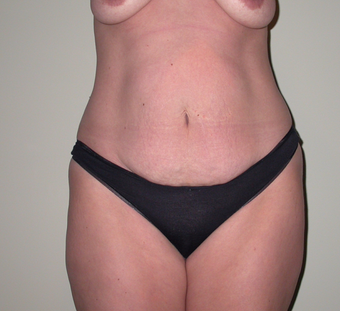 Breast lift, abdominoplasty, liposuction before 273333