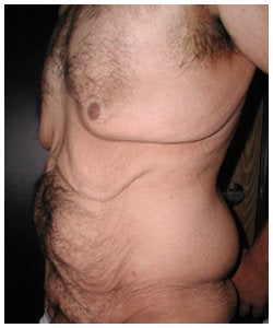 Body Lift and Male Breast Reduction before 334375