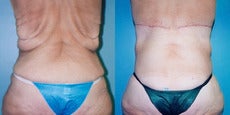 Upper Body & Back Lift After Major Weight Loss before 352830
