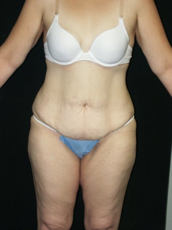Body Lift and Breast Implans before 379786