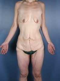 After Weight Loss, Body Lift before 382294